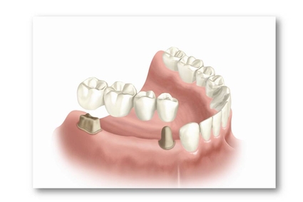 Centre Dentaire IED provides dental crowns and bridges for patients in Pierrefonds & Montreal.