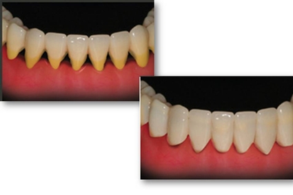 Centre Dentaire IED provides gum disease treatment for patients in Pierrefonds & Montreal.