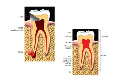 Centre Dentaire IED offers root canal treatment for patients in Pierrefonds & Montreal.
