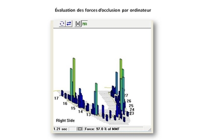 Analyse de l’occlusion en 3D au Centre dentaire IED