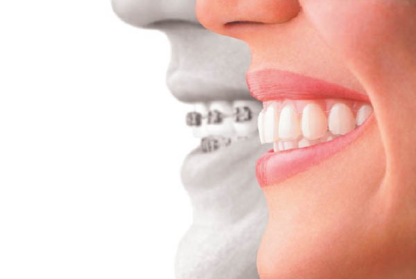 Le Centre Dentaire IED offre des traitements Invisalign pour les patients de Pierrefonds et Montréal.