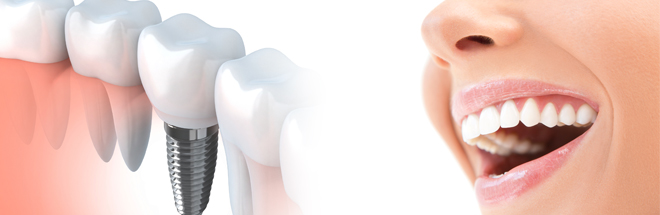 Centre Dentaire IED Implantologie Esthétique Dentisterie Générale Pierrefonds Montréal Quebec Dentistes