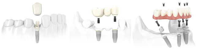 Centre Dentaire IED Implantologie Esthétique Dentisterie Générale Pierrefonds Montréal Quebec Dentistes