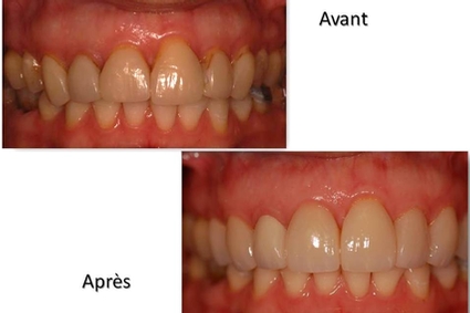 Le Centre Dentaire IED offre des facettes en porcelaine pour les patients de Pierrefonds et Montréal.