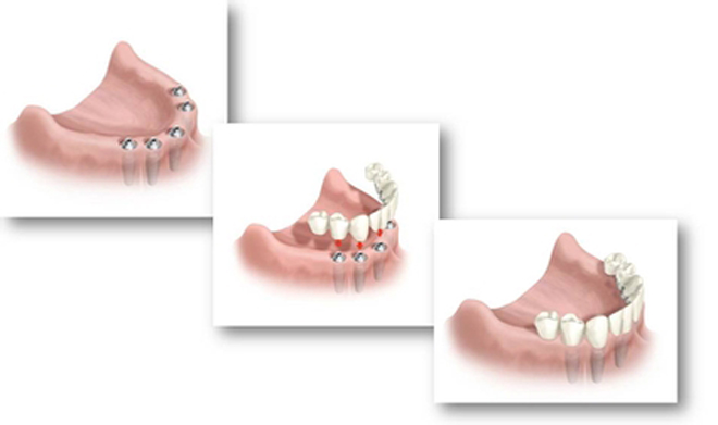Centre Dentaire IED Implantologie Esthétique Dentisterie Générale Pierrefonds Montréal Quebec Dentistes